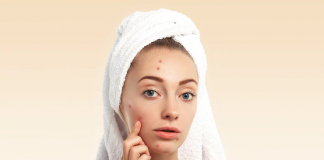 Penyebab Jerawat di Alis dan Cara Menghilangkannya, Perlu Diketahui!